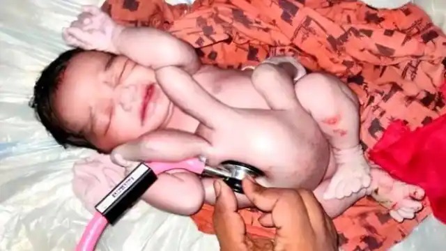 चार हाथ-चार पैर के साथ बच्चे का हुआ जन्म,उमड़ी भीड़.